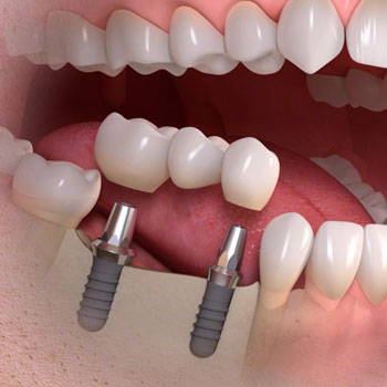 Cấy ghép Implant Nha Khoa