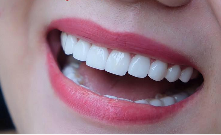 Thẩm mỹ răng sứ cao cấp