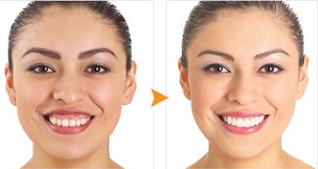 Điều trị cười hở lợi