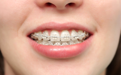 Báo giá dịch vụ chỉnh nha