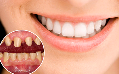 Báo giá nha khoa Phục hình - Thẩm mỹ