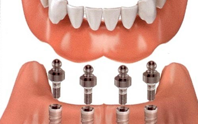 Bảng giá dịch vụ CẤY GHÉP IMPLANT