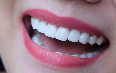 Làm răng sứ thẩm mỹ chuyên nghiệp