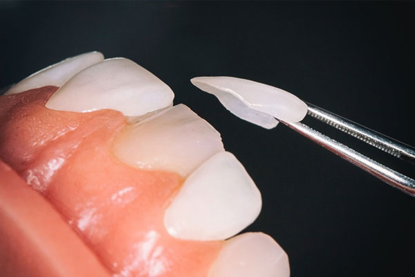 Ưu điểm của mặt dán sứ Veneer