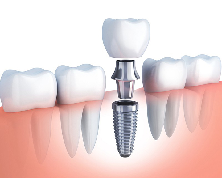  Giá trồng Implant Kinh Môn