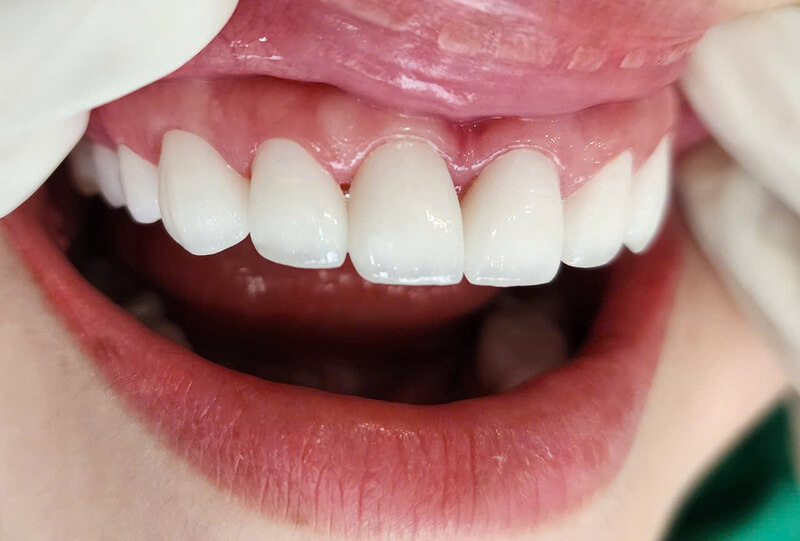 Thẩm mỹ răng sứ tại An Dương Hải Phòng
