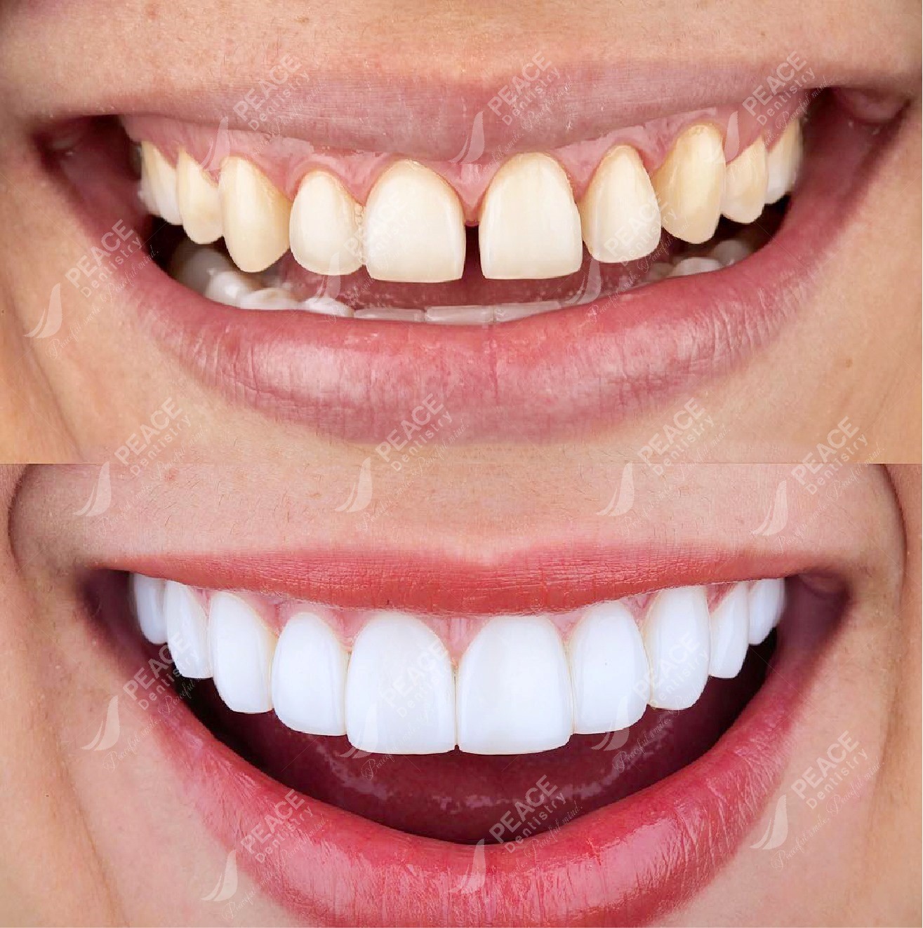 Thẩm mỹ răng sứ tại xã Nam An Phụ